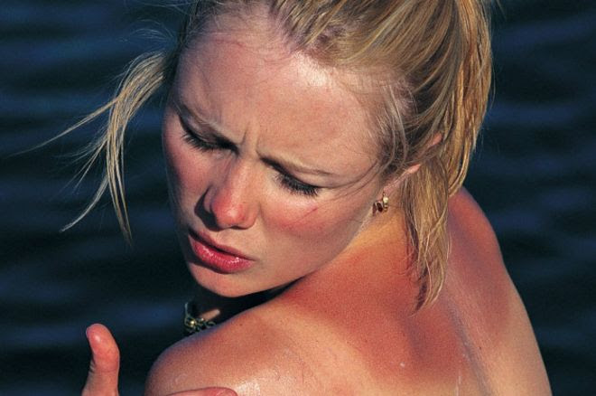 Cómo debes tratar tu piel si te quemaste con el sol