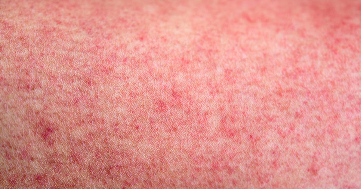 Pinprick Red Dots On Skin Baby 10 Childhood Spots And Rashes