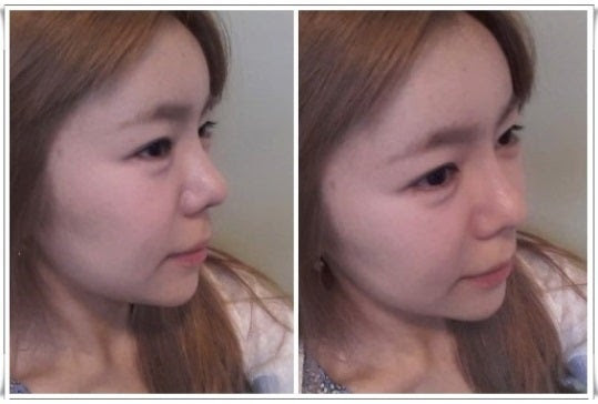 鼻整形、目整形、両顎手術、韓国輪郭
