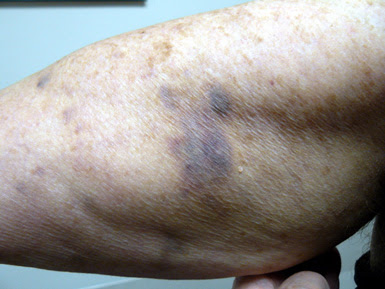CRC-bruises.jpg