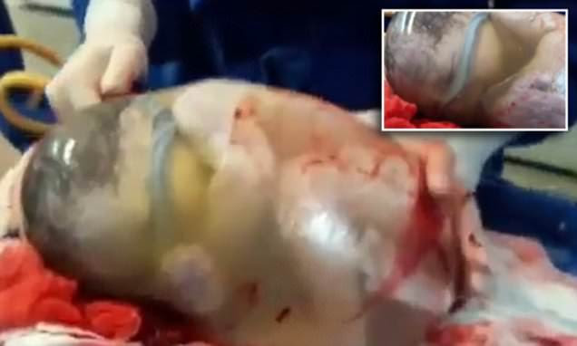 Spanish baby is born while still inside the amniotic sac captured on ...
