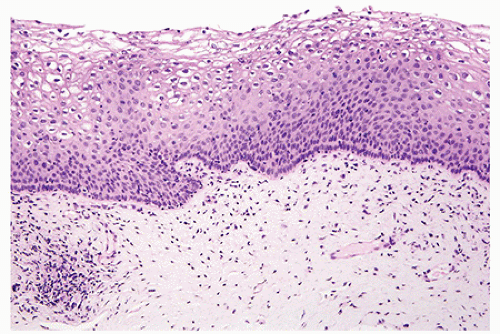 High grade squamous intraepithelial lesion treatment