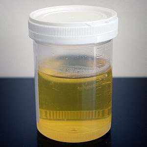 recoltarea urinei pentru proba cu trei pahare