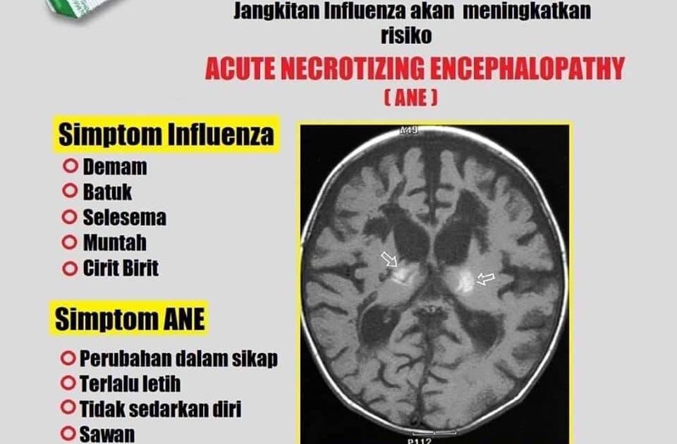Ubat Demam Masuk Punggung Untuk Bayi  Cara Ku Mu
