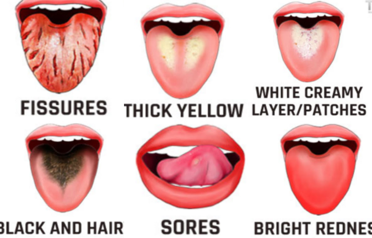 Zungenbelag weisser Weißer Zungenbelag
