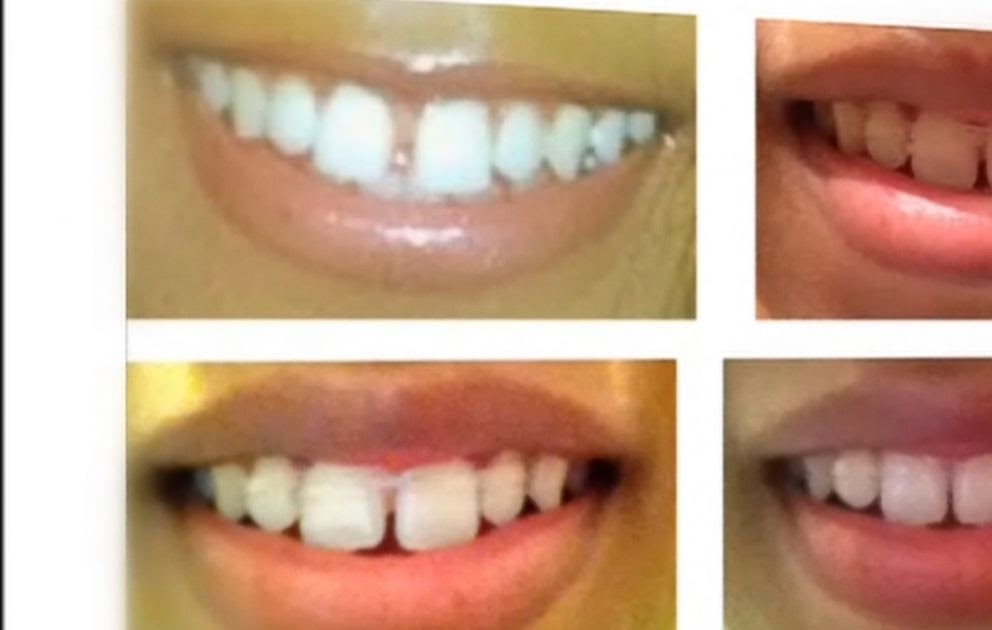 How To Use Rubber Bands To Close Gaps In Teeth Teeth Poster