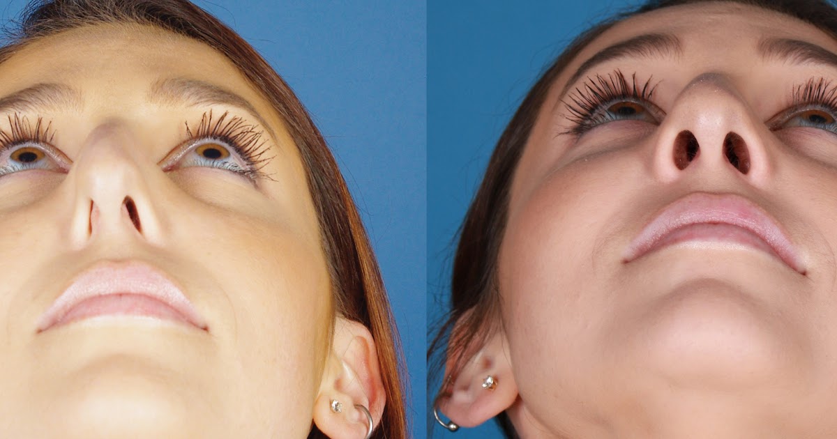 Deviated Septum Covered By Insurance / Fractured Nose