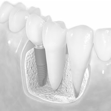 Resultado de imagem para Implantes dentários