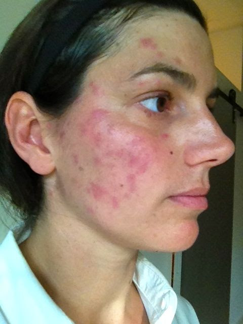 nose sinus piercing problems infection hoop