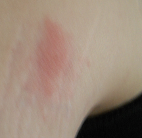 Harrison Buzz: kissing bug bite symptoms