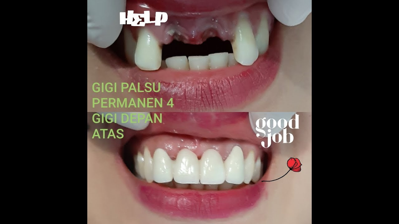 Terbaru 27+ Gambar Lucu Gigi Ompong