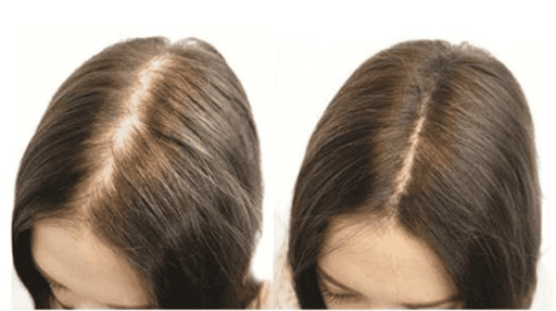 6 CÁCH GIÚP KÍCH THÍCH MỌC TÓC