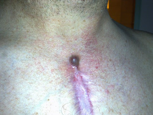 Chest wound