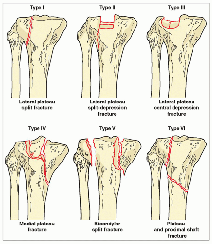 Nondisplaced Lateral Tibial Plateau Fracture