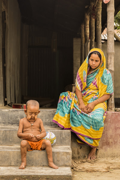 Bayezid Hossain, who suffers aching joints and hollow eyes, with his mum Tripti Khatun Bayezid Hossain