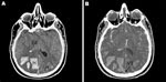 Thumbnail of A) Noncontrast cranial computed tomographic (CT) scan of a 26-year-old immunocompetent man with influenza, showing diffuse cerebral edema (Ed) and bilateral parieto-occipital hematoma (H). B) Cranial CT scan with contrast injection, showing diffuse cerebral edema (Ed) and cord sign (arrow) related to a venous thrombosis (VT) of the superior sagittal sinus.