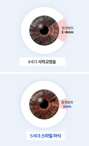 스마트스마일 라식의 차이점을 비교해 보세요! 3