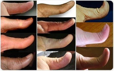 Thumbs ranging from straight to hitchhiker. Image Credit: Myths of Human GeneticsJohn H. McDonald, University of Delaware
