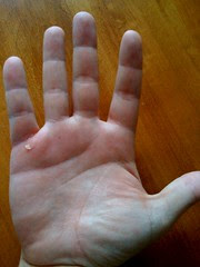 Blister