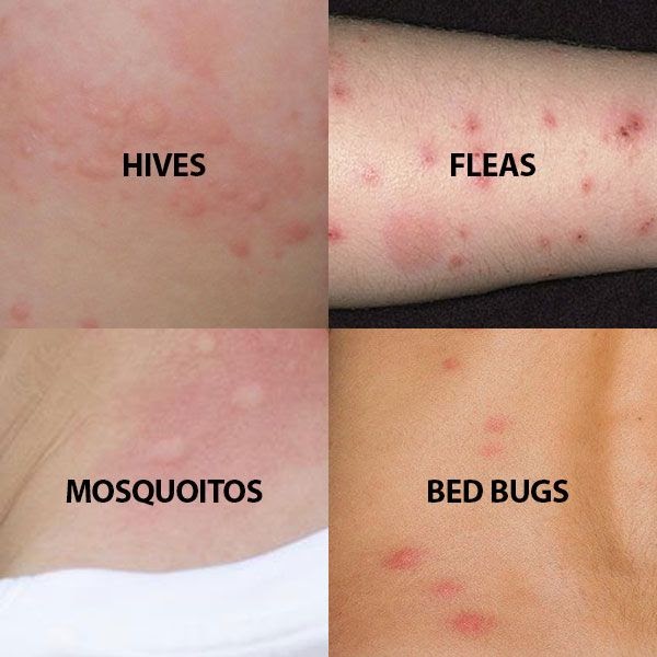 Difference Between Flea Bites And Bed Bug Bites HOME DECOR