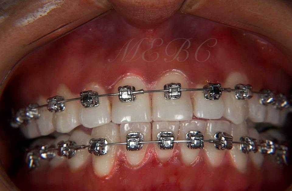 Braces For What Colored Damon Braces