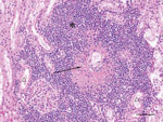 Thumbnail of Kidney of dog infected with Hendra virus, showing marked vasculitis (arrow) and inflammatory infiltrates (*) effacing renal tubules (△). Scale bar indicates 75 μm.
