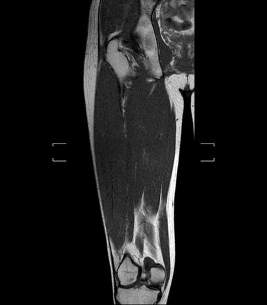 Upper Thigh Muscle Anatomy Mri - Lower extremity: MRI of Anatomical atlas