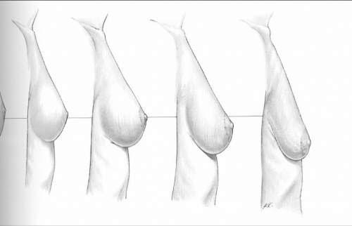 5 Habits You Need to Remove To Prevent Sagging Breasts