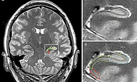 Resonancia magnética de la zona cerebral afectada por el estrés. | El Mundo
