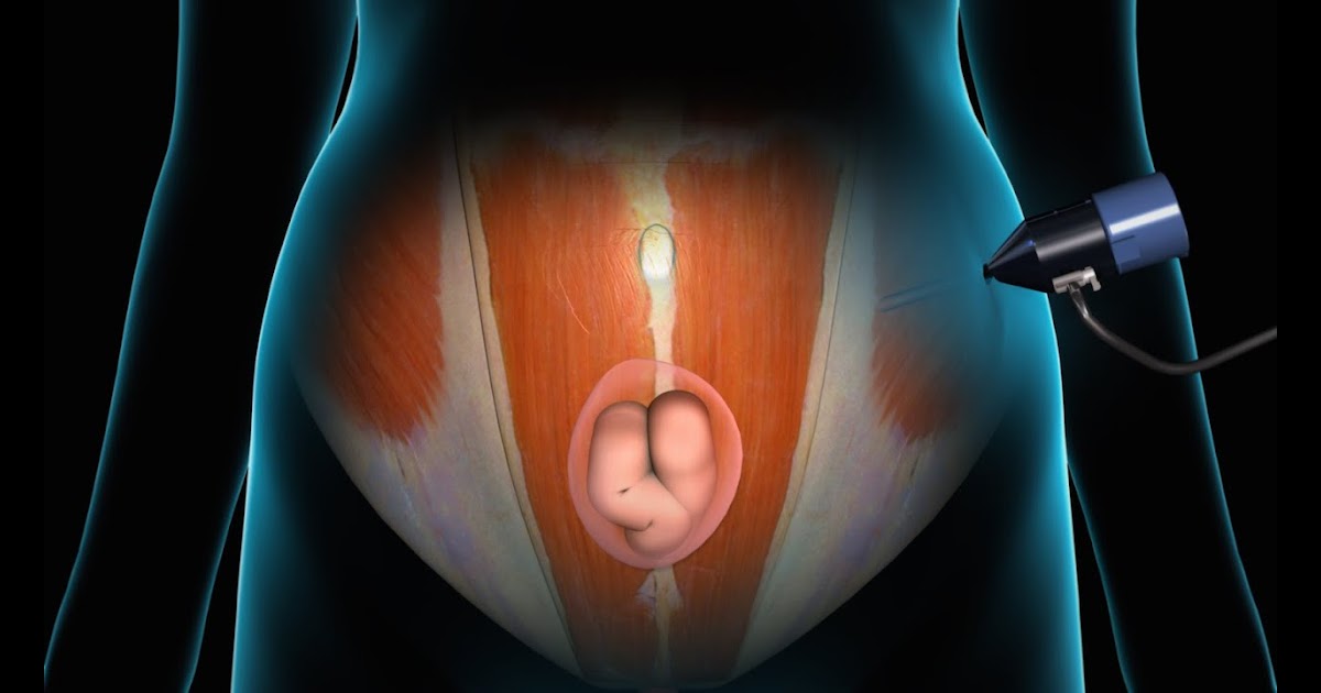 Umbilical Hernia Surgery Pictures furnitdesign