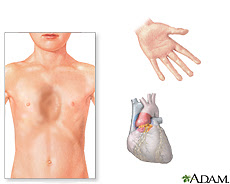 Illustration of some of the manifestations of marfan syndrome