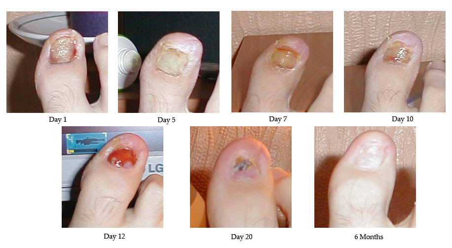 Surgical treatment of ingrown toenails - Wikipedia, the free