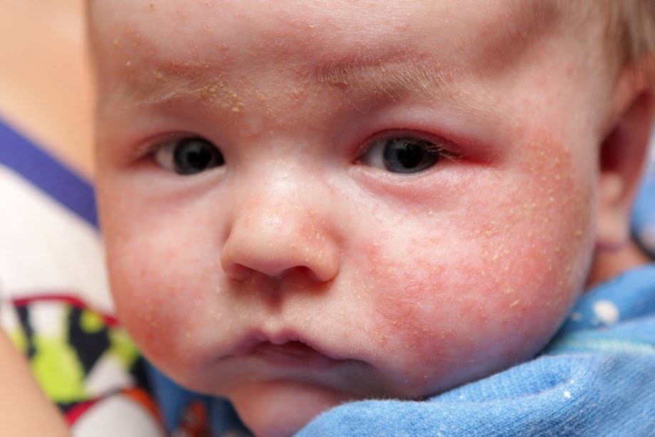 Ubat Eczema Untuk Bayi - Gambleh f