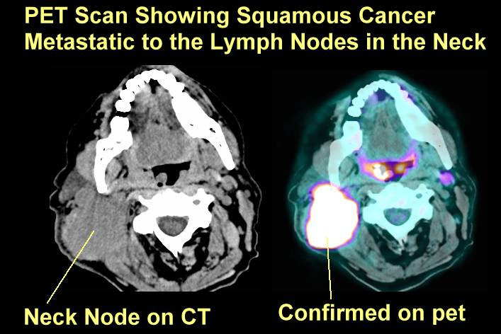 Head And Neck Ct Scan Of Neck Lymph Nodes