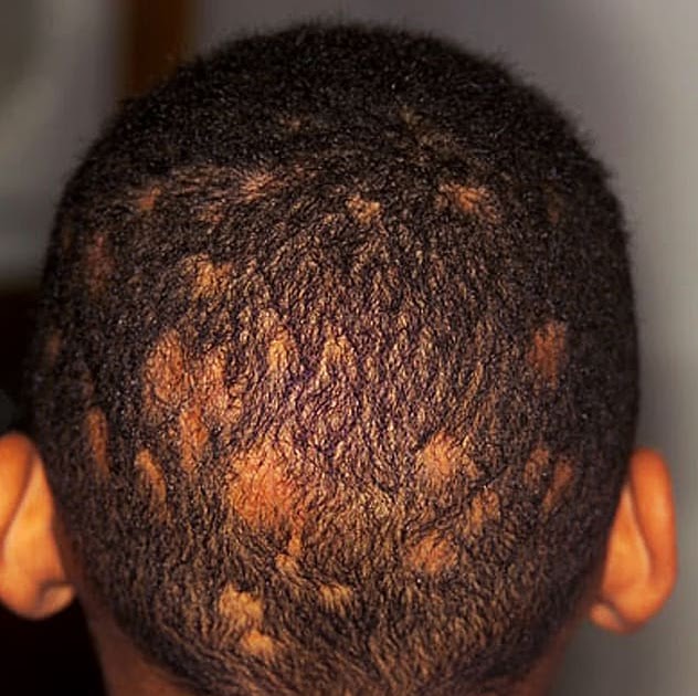 Ringworm In Scalp Pictures