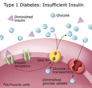 The Disease Type One Diabetes Happens When