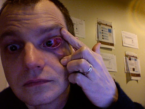 Cyrus's Blog subconjunctival hemorrhage pics