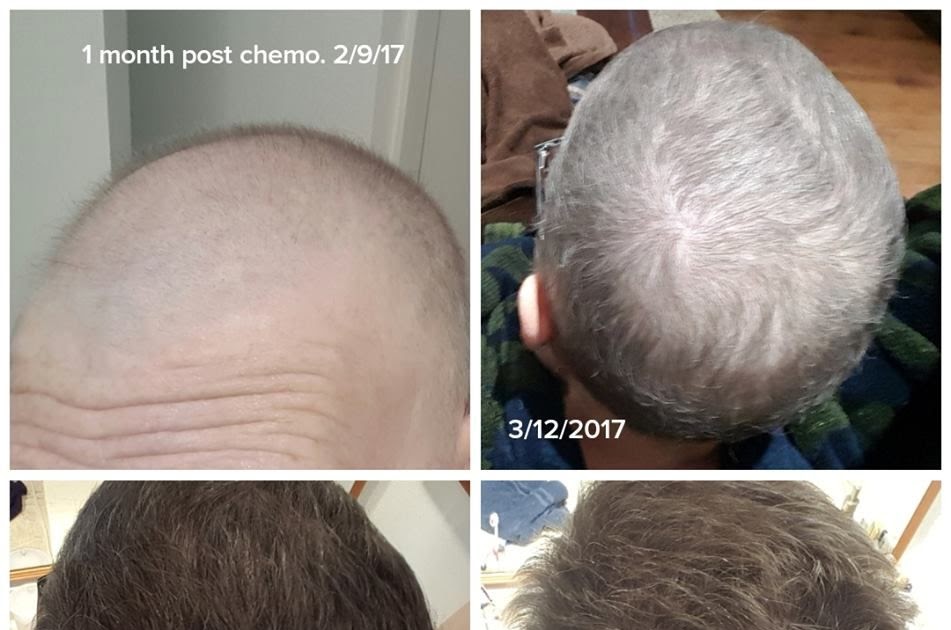Hair Growth 6 Weeks After Chemo - These Will Be the 10 Biggest Hair