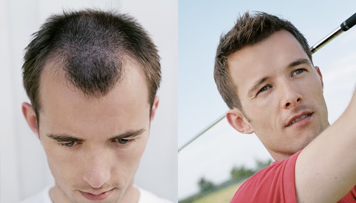 63 Cute How to fix male receding hairline for Oval Face