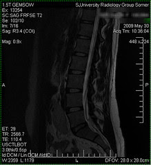 My spine as taken during my lumbar MRI on 5/30/09