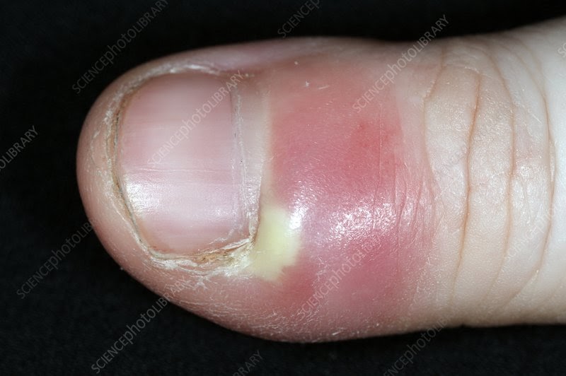 What Kind Of Doctor For Infected Finger