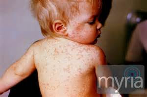 Measles Symptoms