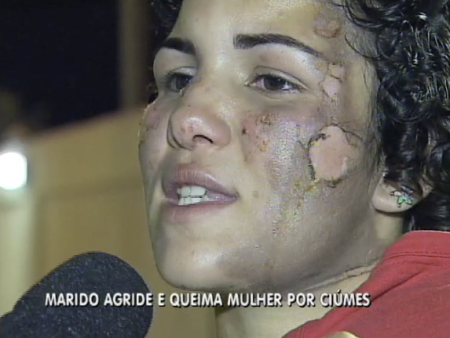 mulher queimada