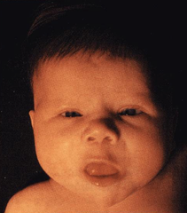 Gravid mor: Hypothyreose symptomer Gravid mor: Hypothyreose symptomer