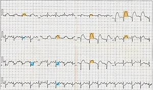12 Lead ECG EKG showing ST Elevation (STEMI), ...