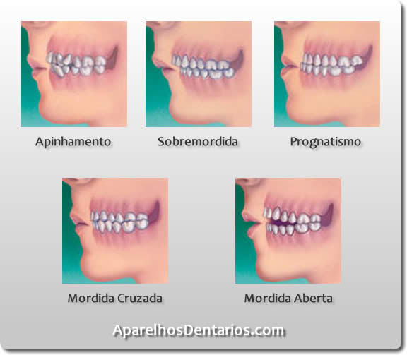 Tipos de Mordida Tipos de Mordida