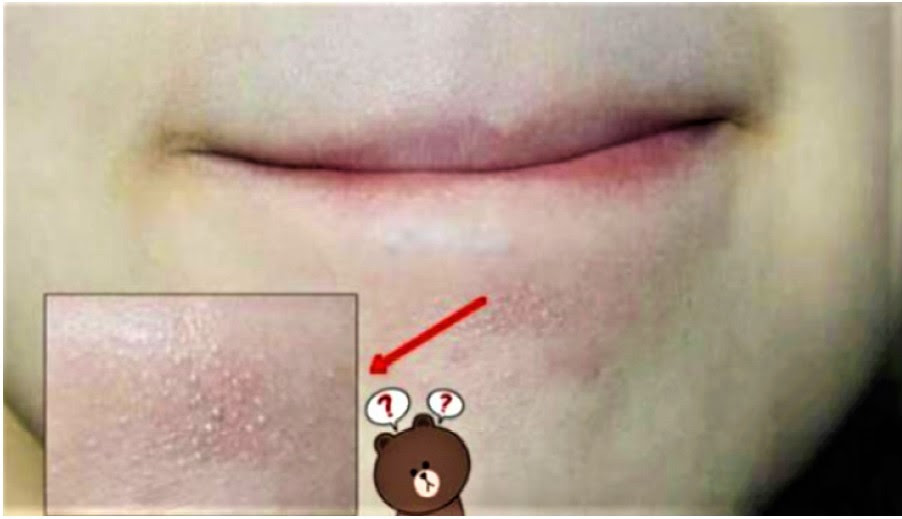 Kelenjar Bengkak Di Bawah Dagu / Ketika gejala getah bening anda