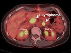 CT cross-section scans of abdomen with left image showing lymphoma highlighted in yellow and right image showing disappearance of cancer after 8 weeks on cancer drug ibrutinib.