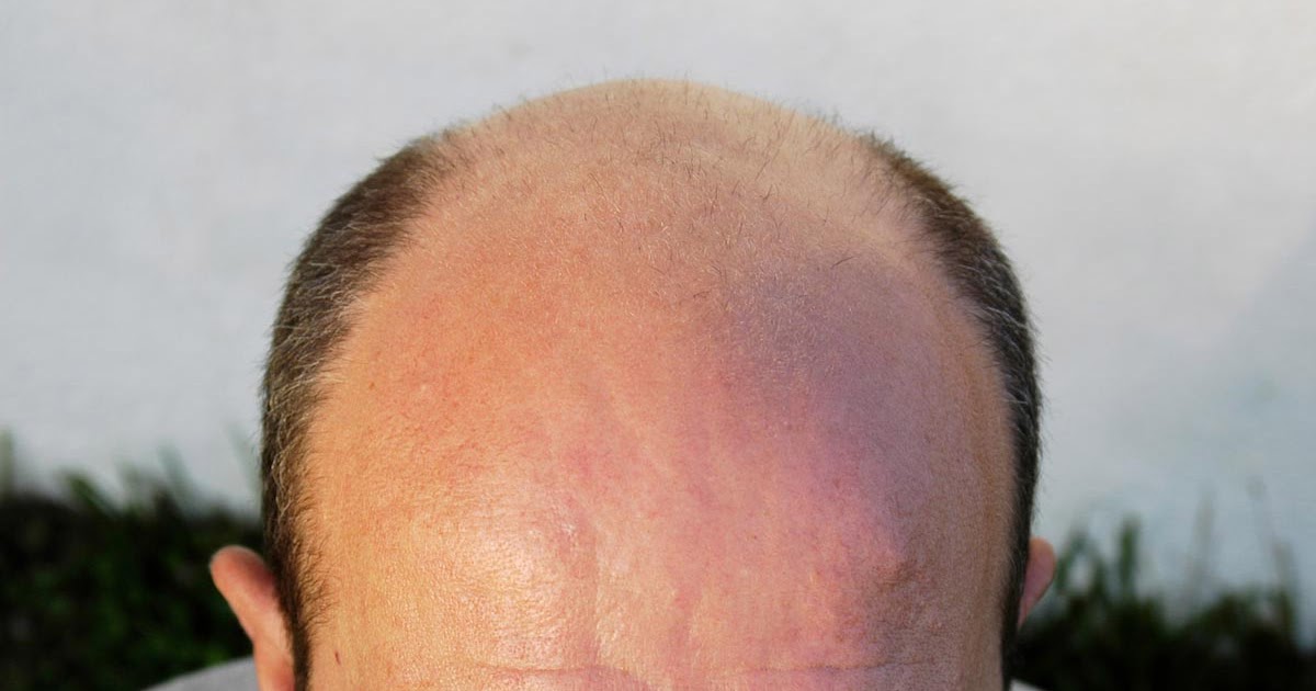 can rogaine cause more hair loss
