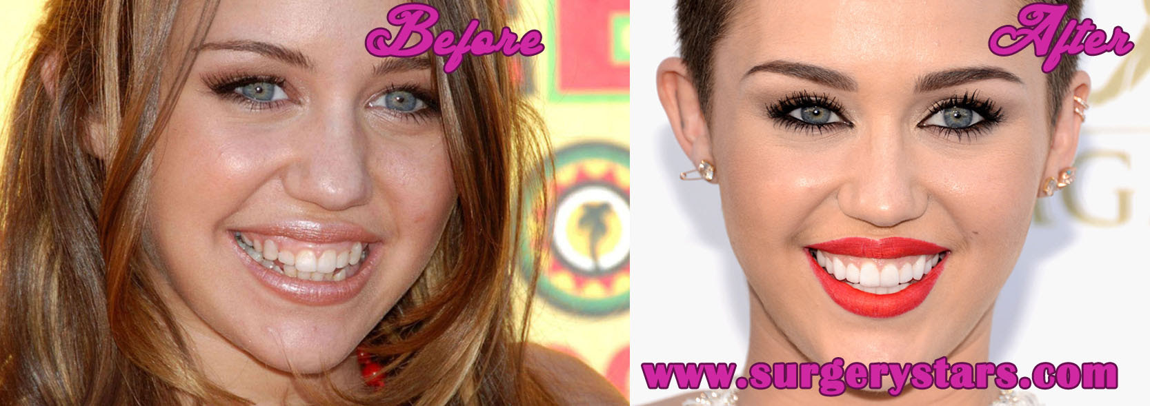Miley Cyrus Before After Teeth ictendavraniyor
